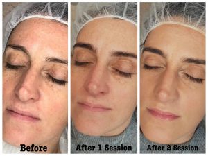 BB GLOW BEFORE AFTER PHOTO