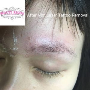 Non laser tattoo phiremoval singapore
