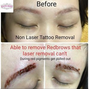 Non laser eyebrow tattoo phiremoval singapore