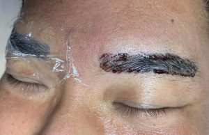 Non laser tattoo phiremoval singapore