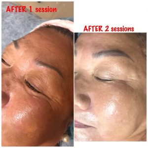 Needleless PDO threadlift results thesera L 5