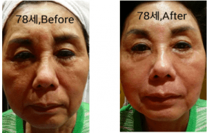 Needleless PDO Thread Lift now in Singapore 4