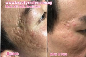 Stem cell skin treatment singapore