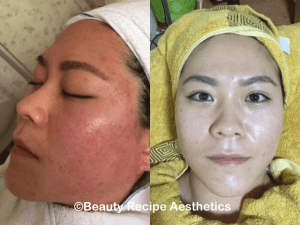 Acne Facial Singapore 2