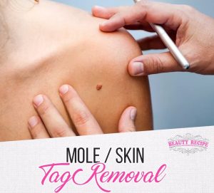 Mole Skin Tag Milla Seed Removal Singapore
