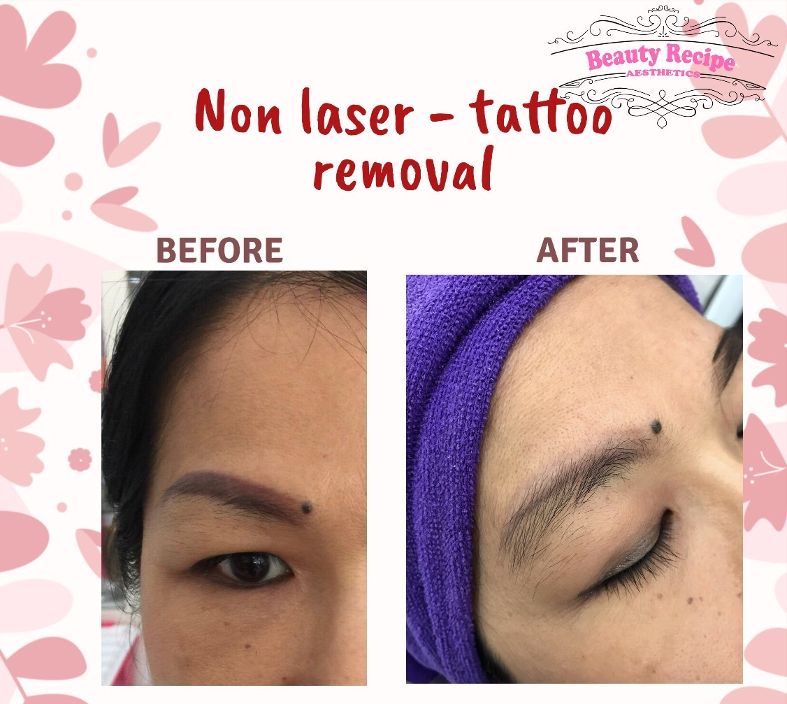 Saline  Glycolic Acid Tattoo Removal  Pmubysophia