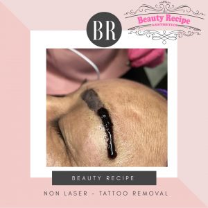 Non laser tattoo phiremoval