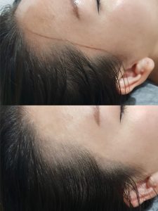 Hairline Embroidery micro pigmentation restoration Singapore