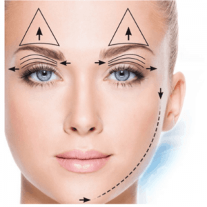 Plasma Fibroblast Face Lift Acne Scars Stretch Marks Training Course Singapore
