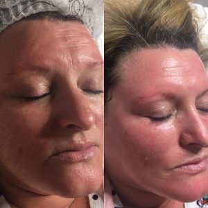 micro botox infusion facial before after singapore