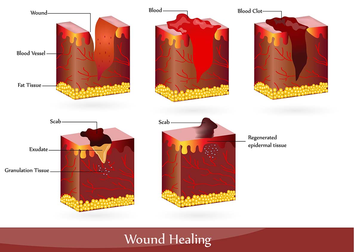 wound healing process