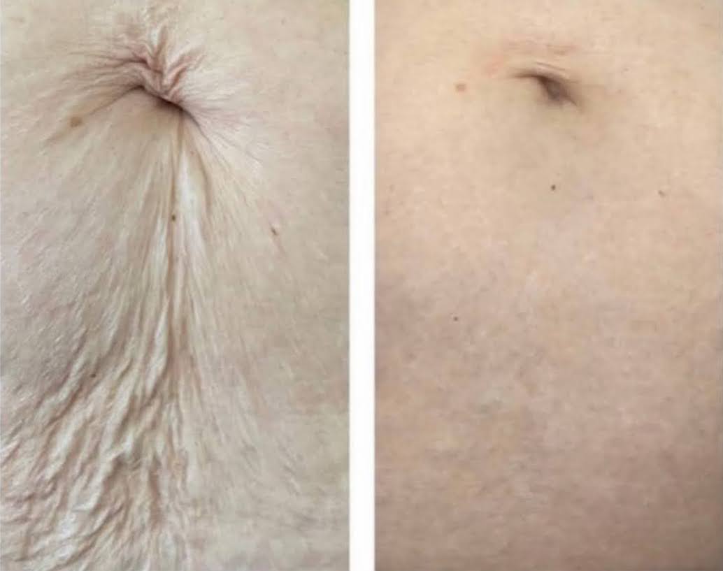 before and after Plasma tummy tightening