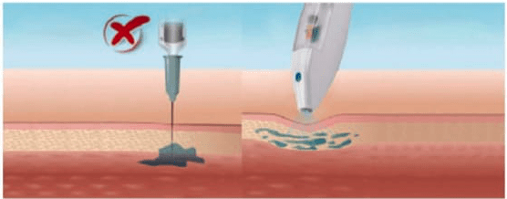 Needle Free Skin Booster Mesotherapy 