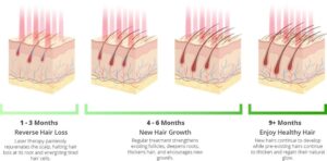 Laser Therapy For Hair Loss Treatment | Low Laser Scalp Treatment