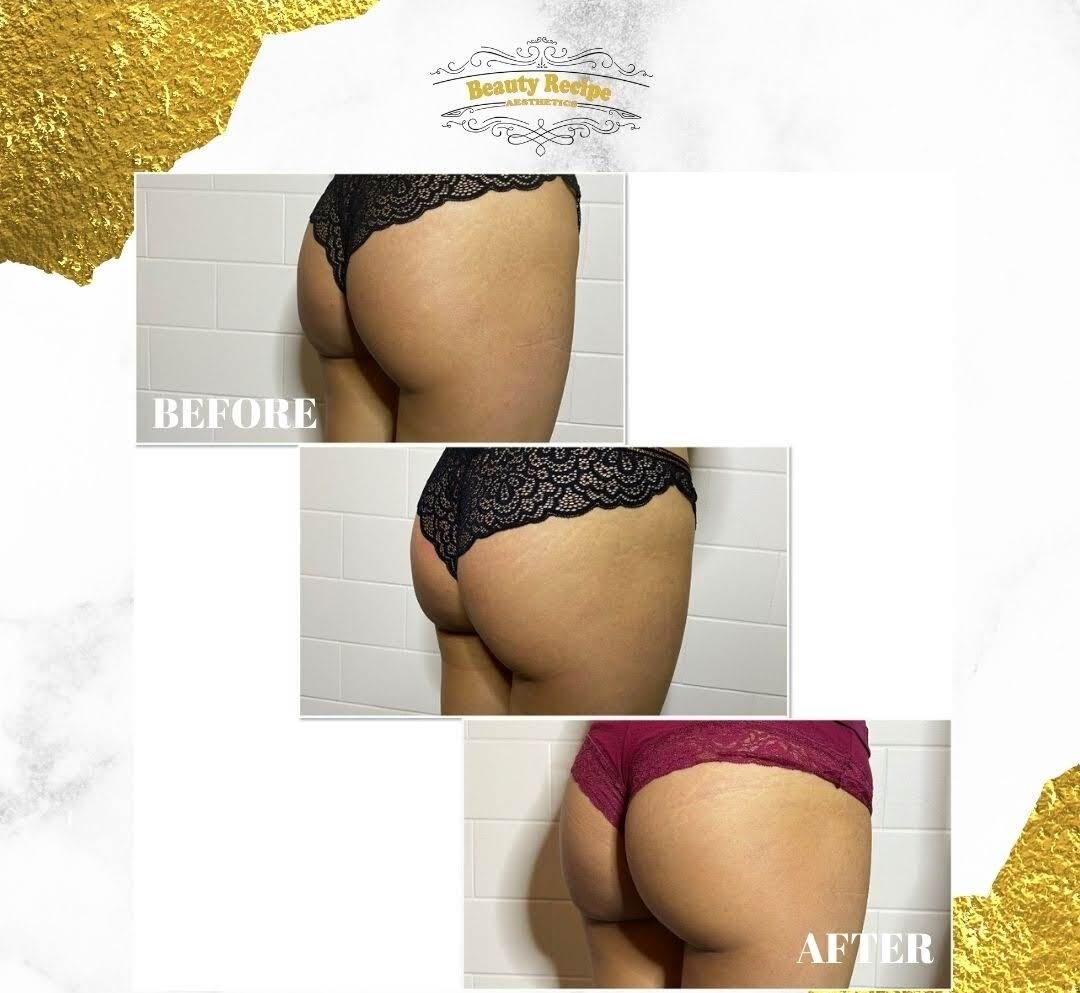 Before and After Buttocks EMS Treatment