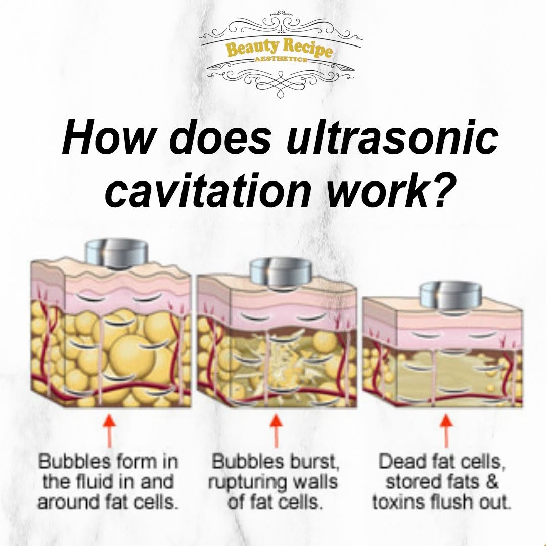 Ultrasound Lipo Cavitation Singapore Slimming Weight loss