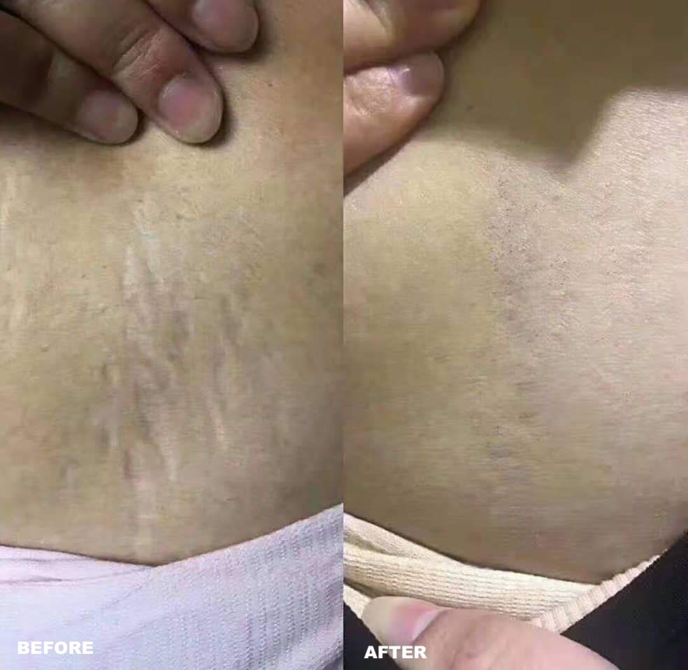 Stretch Marks before and after treatment