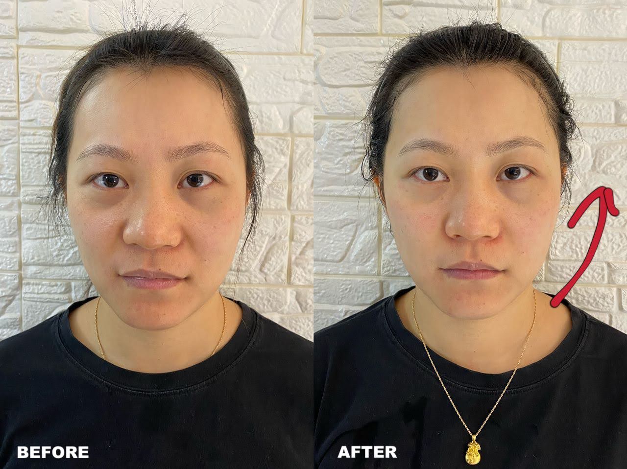 Before and after Fractional RF Microneedling treatment